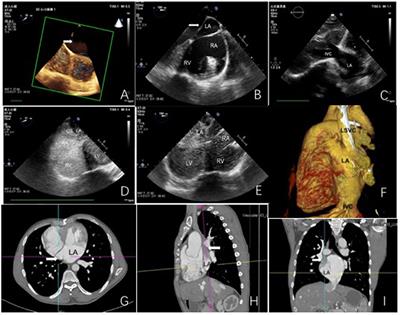 Multimodal Imaging for Total Anomalous Systemic Venous Drainage Diagnosis and Preoperative Planning: A Case Report and Literature Review